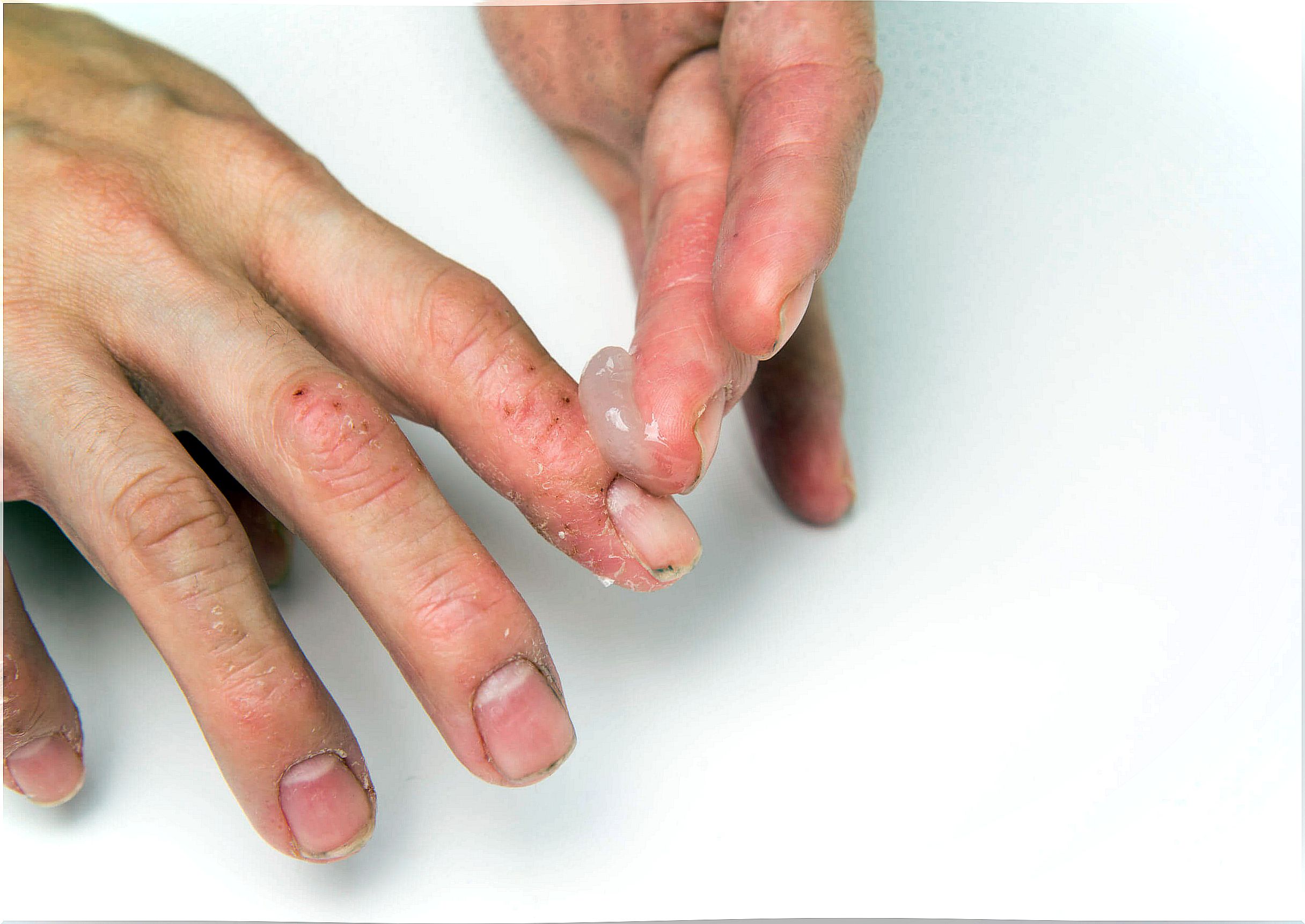 Dyshidrotic eczema in children: how to treat it?