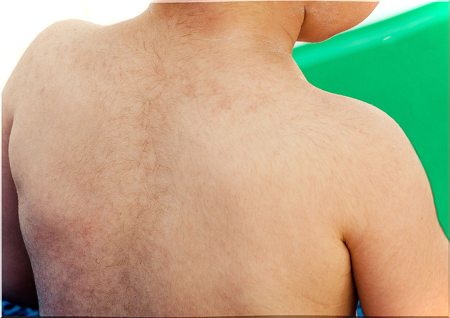 Child with hypertrichosis.