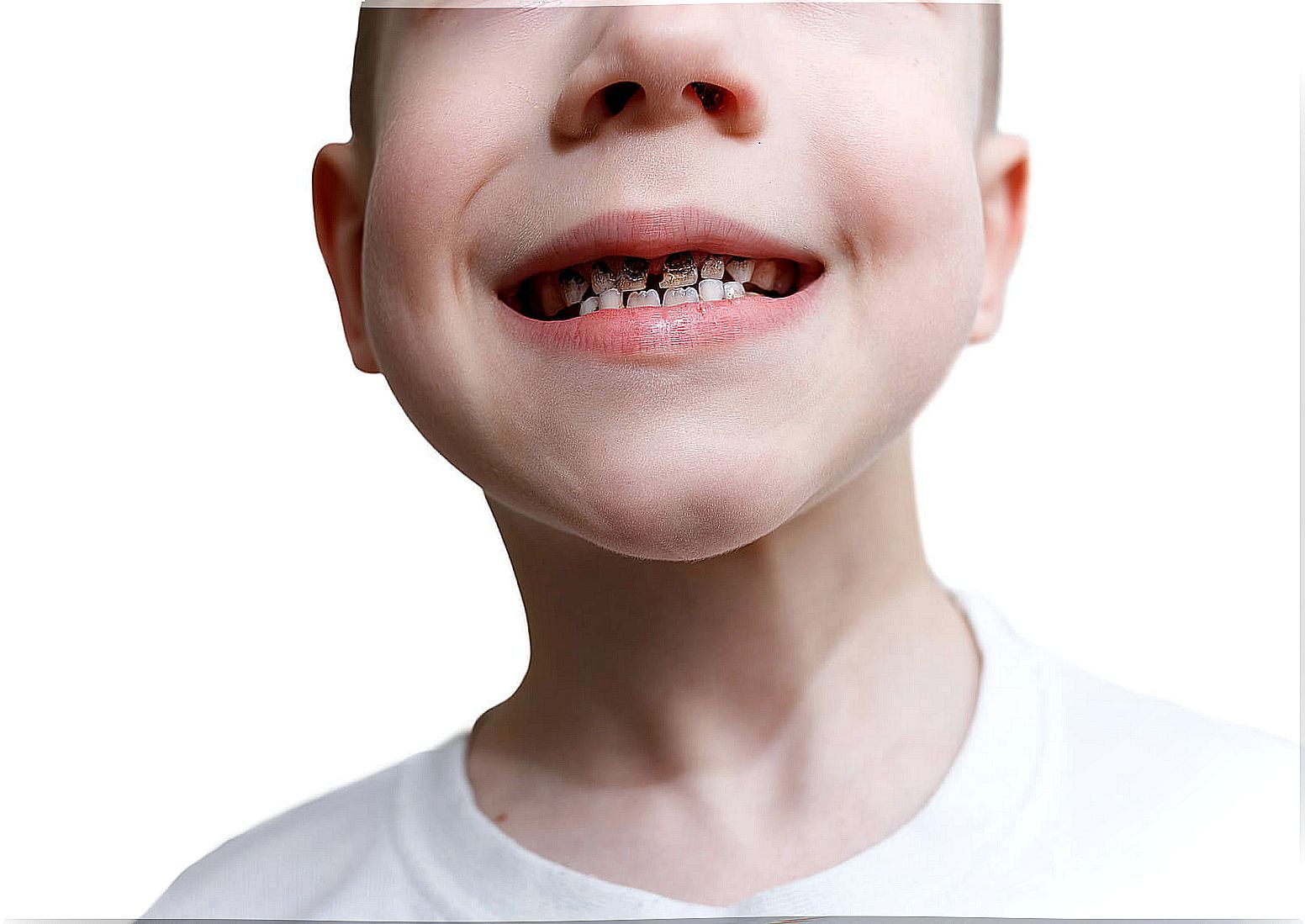 Child with black teeth from cavities.